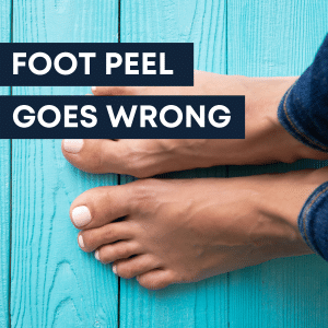 foot peel goes wrong